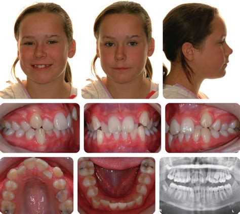 3 Class I Malocclusion | Pocket Dentistry