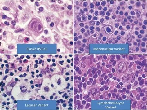 amyloidosis kidney histology