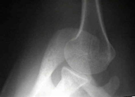 Axillary View of the Shoulder : Wheeless' Textbook of Orthopaedics