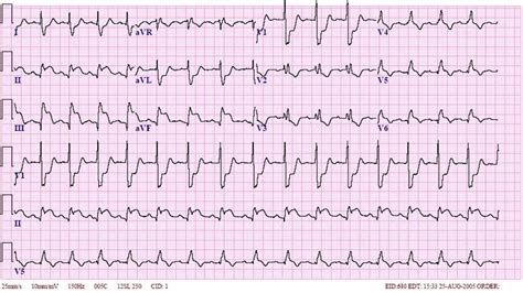 Inferior Wall MI with RBBB ECG (Example 2) | Learn the Heart