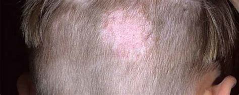 Scalp Ringworm - Symptoms And Causes