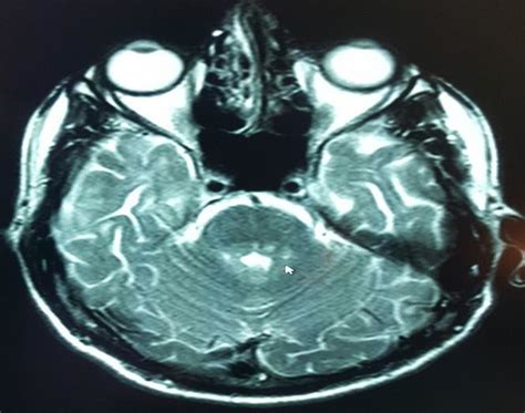 T2 weighted MRI revealed a hyperintense lesion in the midline and left... | Download Scientific ...