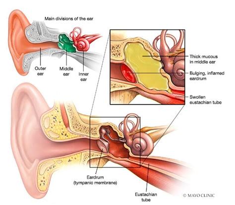 Ear infection (middle ear) | Beacon Health System