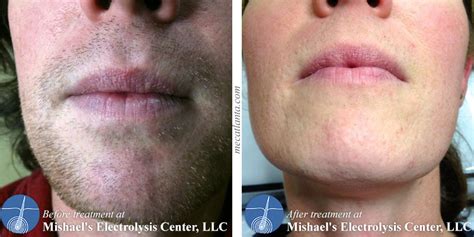 Before & After Electrolysis Hair Removal | Mishael's Electrolysis Center