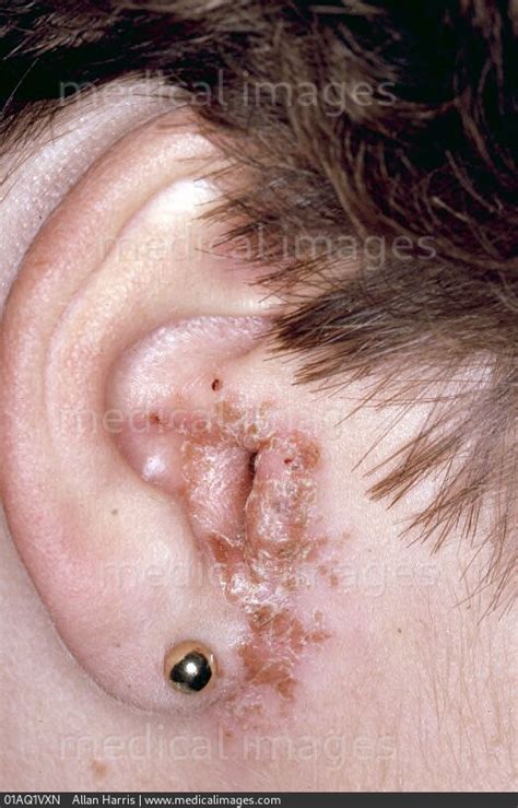 STOCK IMAGE, dermatology fungal otitis externa crusty and peeling skin ...