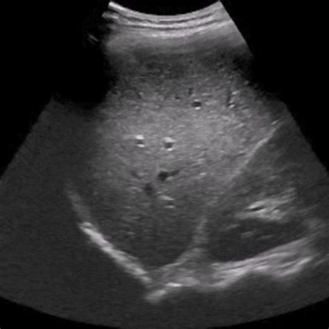 Liver Ultrasound Anatomy