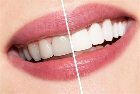 Teeth Whitening Can Help Your Smile Sparkle - Smile Fitness Dental ...