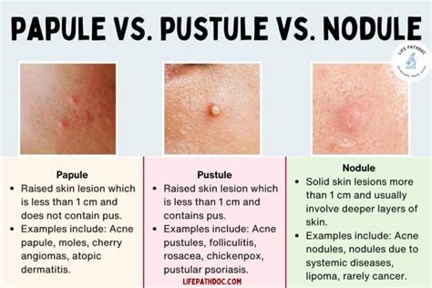 Papule vs Pustule vs Nodule: Pictures, Differences, and Causes