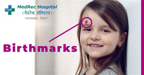 Birthmark : Types, Causes, Complications And Treatment