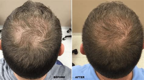 fue hair transplant after 20 days - Azzie Reaves