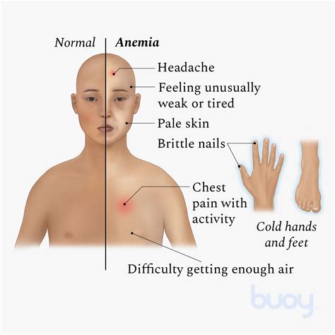 Virus Odds Retire what does lack of iron cause Arne Additive past