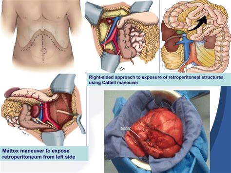 Retroperitoneal mass