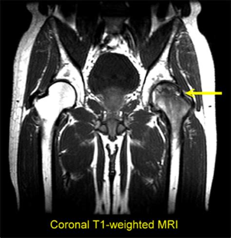 Avascular Necrosis of the Femoral Head - Diagnosis, Treatment, and Total Hip Replacement | HealDove