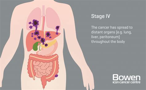 What is Bowel Cancer? Bowel Cancer Explained — Bowen Icon Cancer Centre