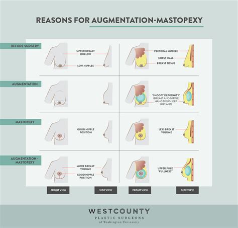 Breast Lift And Augmentation Recovery Timeline - Cosmetic Surgery Tips