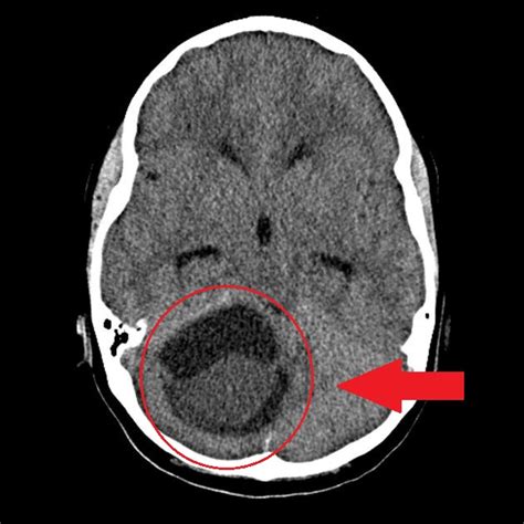 Astrocytoma CT - wikidoc