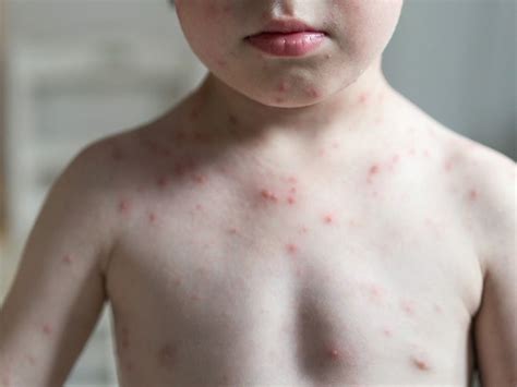 Fever with rash in child: Pictures, causes, and treatments