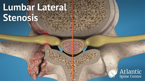 Lateral Recess Lumbar