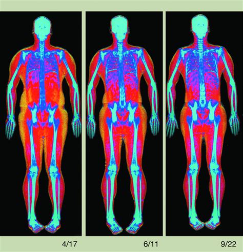 Too Much Fat? Try a Whole-Body Scan - WSJ