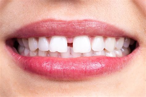 Diastema (Gap Teeth): Causes and How to Fix Gap Teeth | Living Well ...