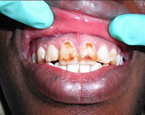 PDF: Factors associated with dental fluorosis - Odontología Virtual