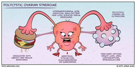 Polycystic Ovary Syndrome | 7450 Case Study