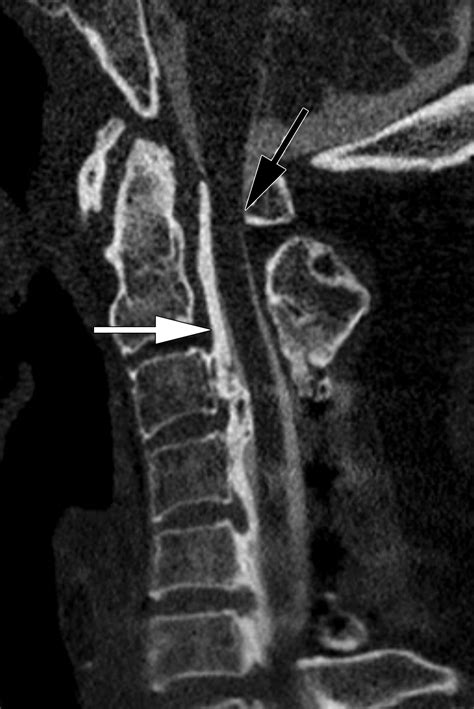 CT Myelography: Clinical Indications and Imaging Findings | RadioGraphics