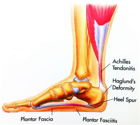 Heel Spur Syndrome | Foot & Ankle Doctors, Inc.