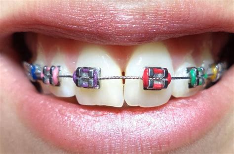 Pick your best one with the help of braces color wheel | Braces colors, Braces color wheel, Braces