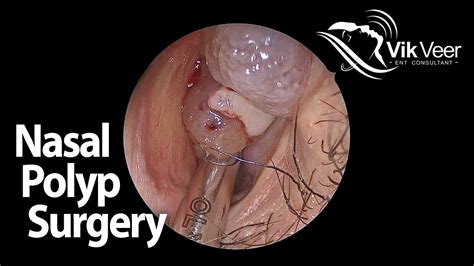 Nasal Polyps Surgery