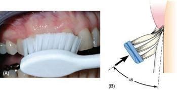 Tooth Brushing Methods | Bass & Modified Stillman Technique | Dentistry