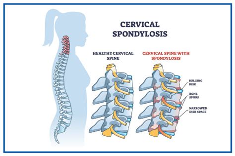 Cervical Spondylitis | Good Living Medical Centre Dubai