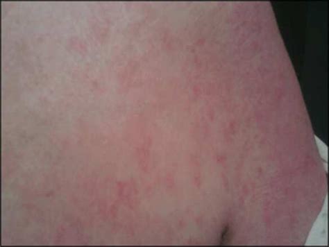 I have a skin condition. It started as red splotches on the