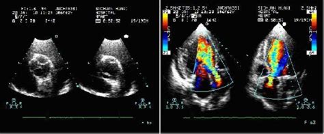 The preoperative transthoracic echocardiogram (TTE) disclosed a ...