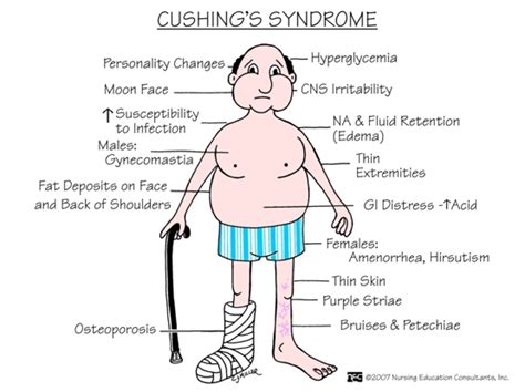 Cushing's Syndrome: Signs and Symptoms