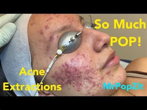 So much pop! Acne extractions on severe inflammatory acne - Mr Pop Zit ...