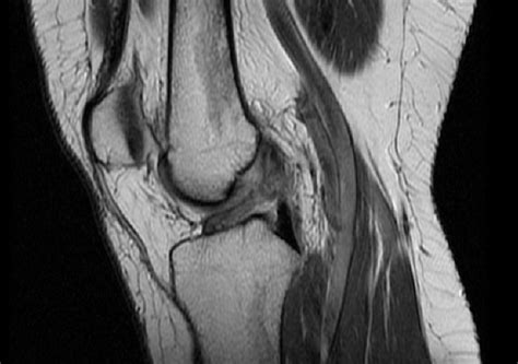 MRI of my torn ACL