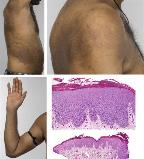 (a-e) Patient 4, a 34-year-old man with a 13-year history of psoriasis,... | Download Scientific ...