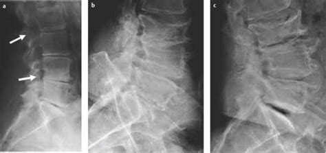 Vacuum in the Body - Clinical Radiology - GUWS Medical