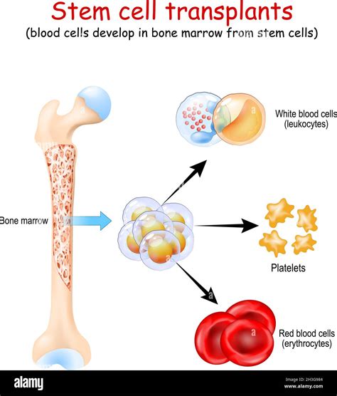 Stem cell transplants. blood cells develop in bone marrow from stem ...