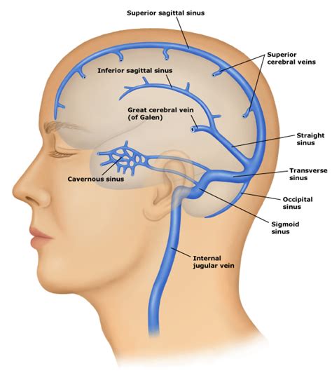 Dr K K Aggarwal: Hillary Clinton being treated for transverse sinus ...