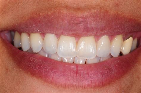 Before/After Photos - Dentist Honolulu, HI | Dental Day Spa