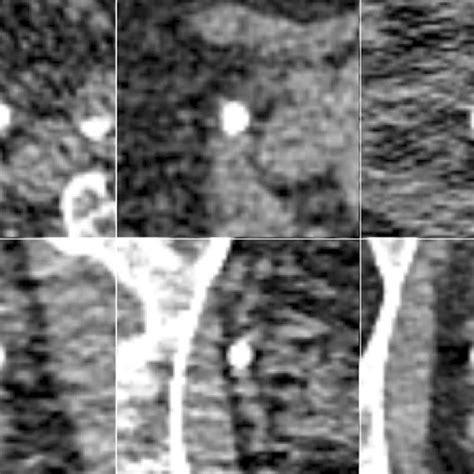 (PDF) Differentiation of distal ureteral stones and pelvic phleboliths using a convolutional ...