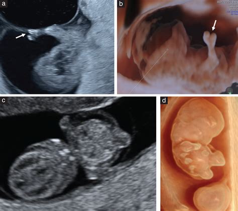 Sonographic Detection Of Fetal Abnormalities Before 11, 43% OFF