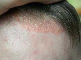 Shingles on scalp-Causes, 13 Symptoms, 12 Treatments