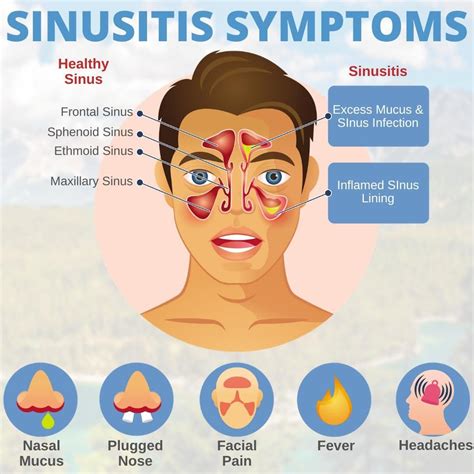 👃 #DidYouKnow nearly 35 million Americans have sinusitis. Inflamed or ...