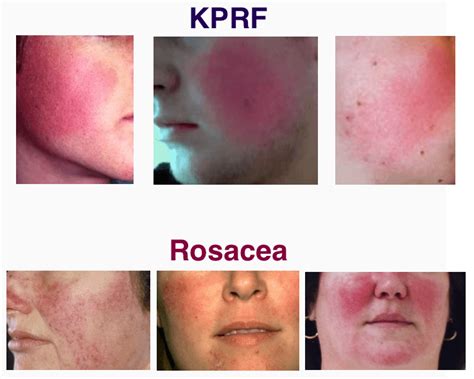 [Skin Concerns] Keratosis Pilaris Rubra Faceii Solution - Any products ...