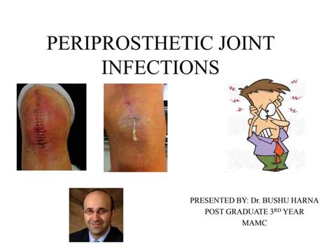 Periprosthetic joint infection