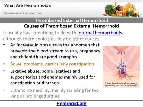 Thrombosed External Hemorrhoid