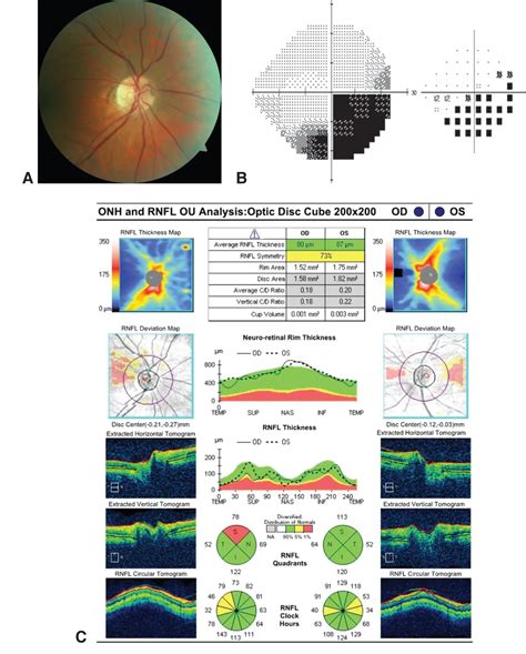 Optical coherence tomography - American Academy of Ophthalmology